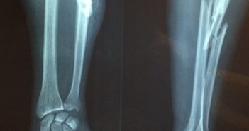 What Is Forearm Tendonitis? Why Should You Worry About It?