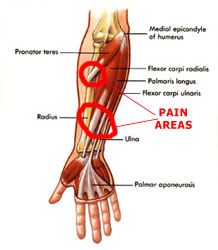 Understanding Forearm Tendonitis